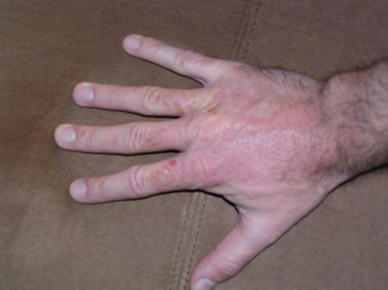 poison oak rash poison oak rash pictures. poison oak rash
