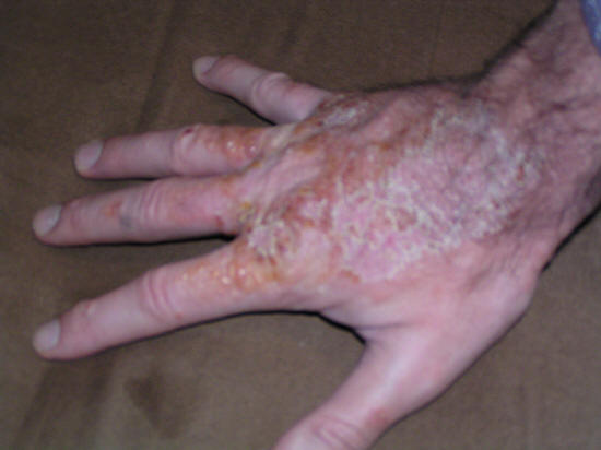 Peeling and Flaking Skin: Check Your Symptoms and Signs