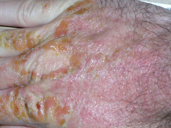 poison oak rashes. poison oak rash pictures.