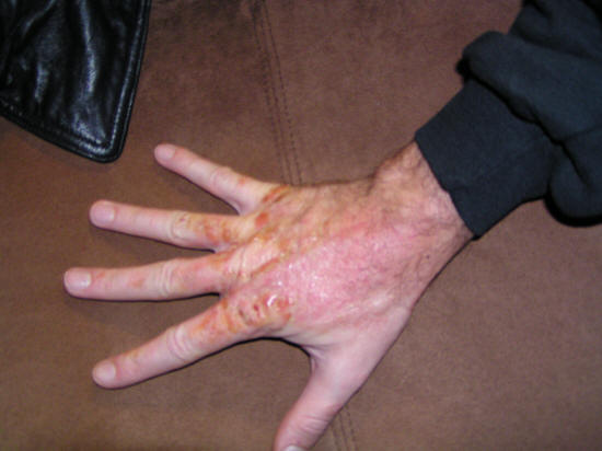 poison ivy poison ivy and poison oak pictures. poison ivy