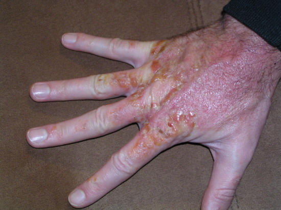 More about my poison oak fight